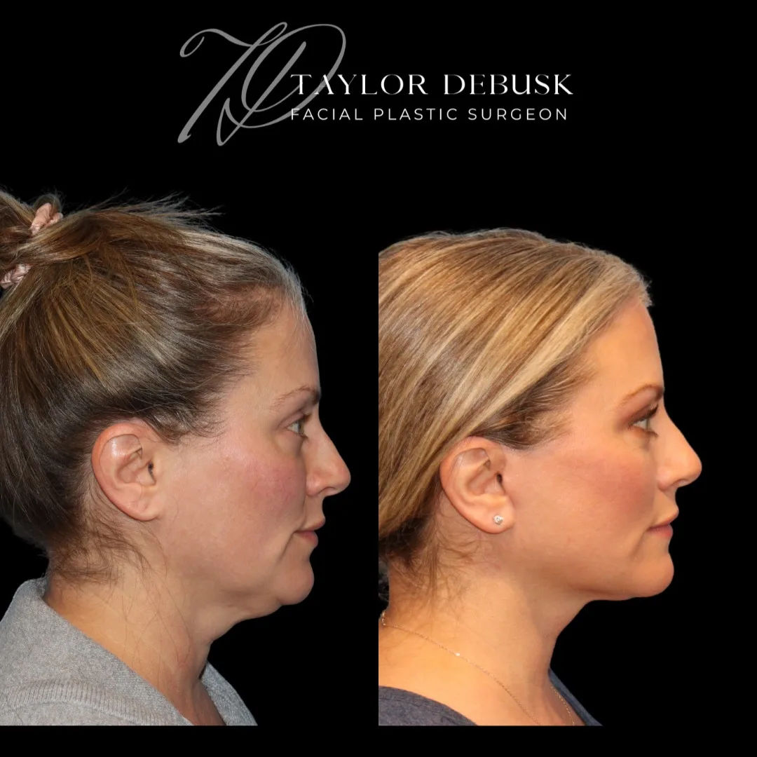 Before and after deep plane facelift — 45-year-old woman, right profile view, 3mo post-op by Dr. Taylor DeBusk