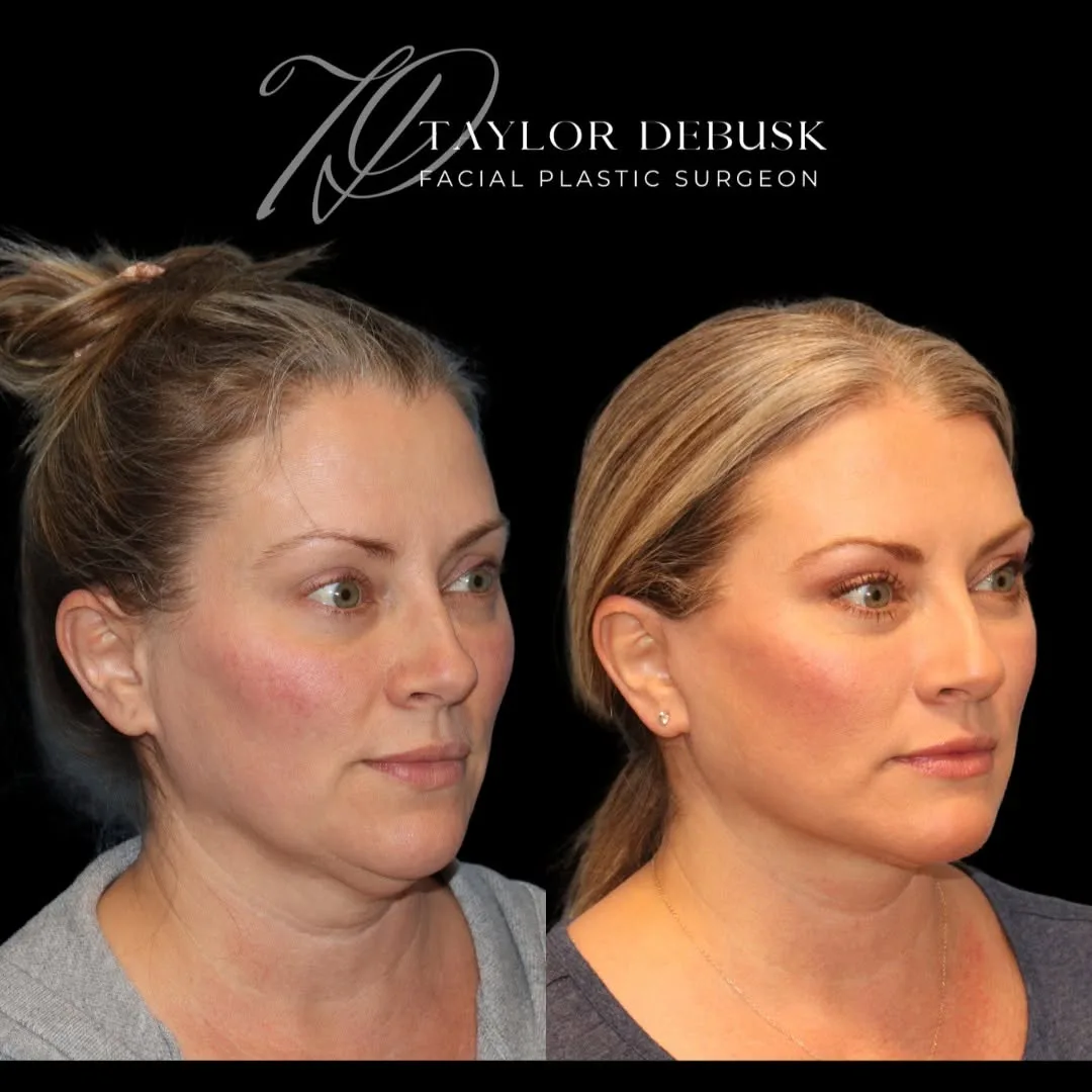 Before and after deep plane facelift — 48-year-old woman, three-quarter view, 3mo post-op by Dr. Taylor DeBusk