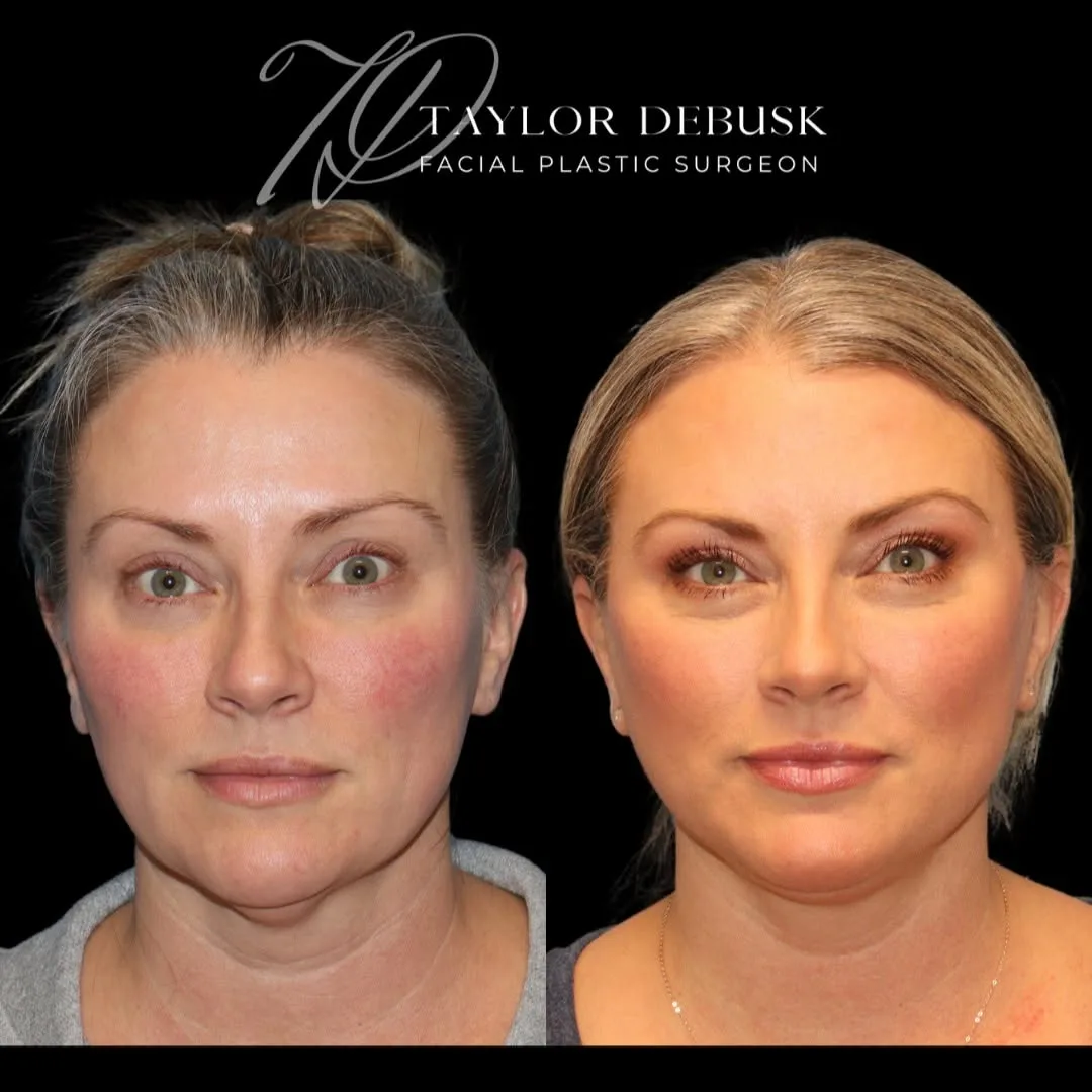 Before and after deep plane facelift — 48-year-old woman, frontal view, 3mo post-op by Dr. Taylor DeBusk