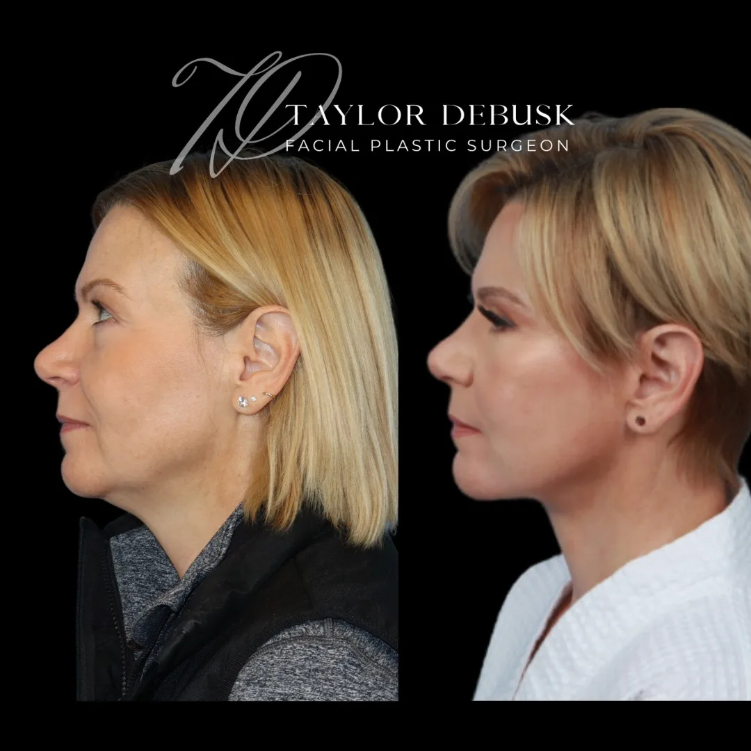Before and after deep plane facelift — 52-year-old woman, left profile view, 12mo post-op by Dr. Taylor DeBusk