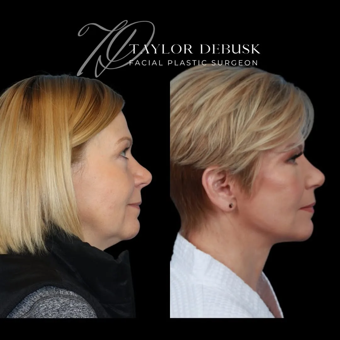 Before and after deep plane facelift — 55-year-old woman, right profile view, 12mo post-op by Dr. Taylor DeBusk