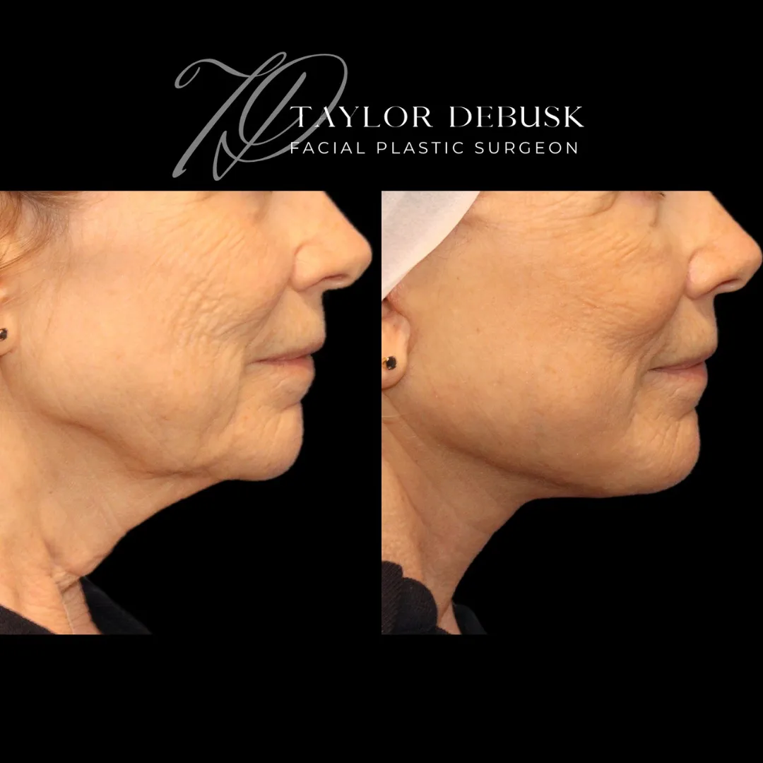 Before and after deep plane facelift — 58-year-old woman, three-quarter view, 1mo post-op by Dr. Taylor DeBusk