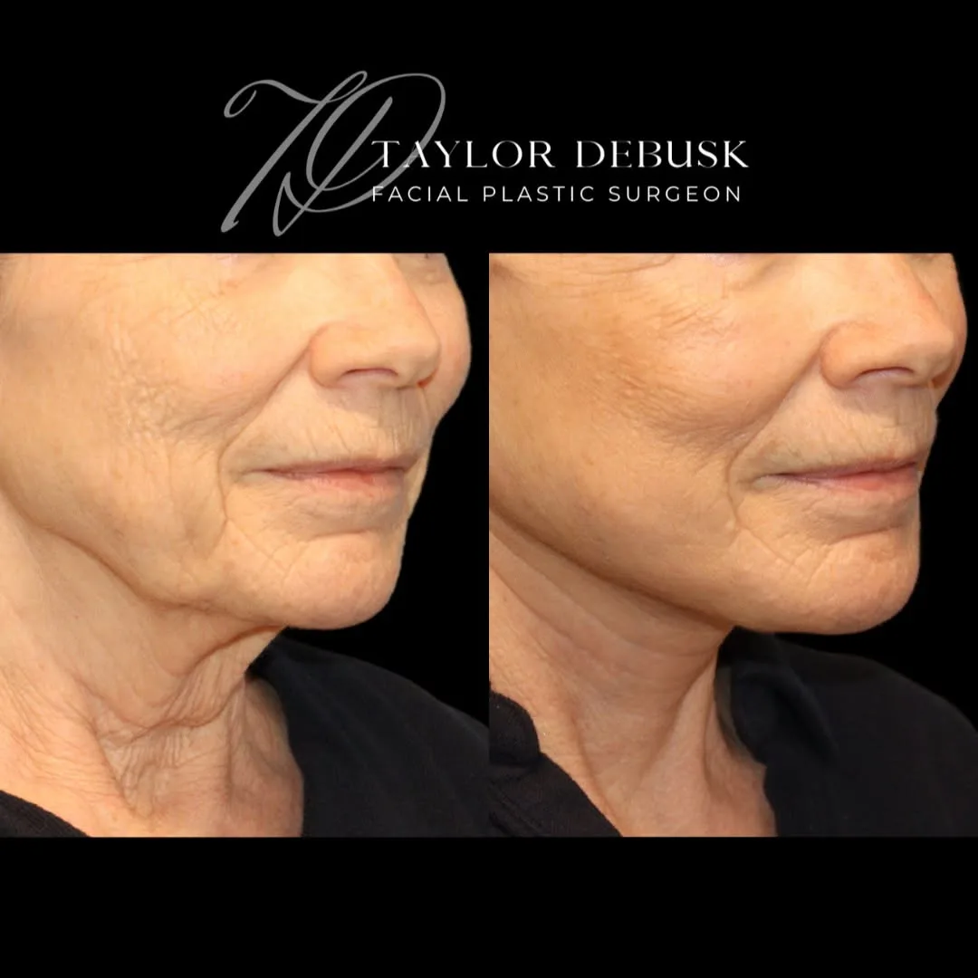 Before and after deep plane facelift — 74-year-old woman, three-quarter view, 1mo post-op by Dr. Taylor DeBusk