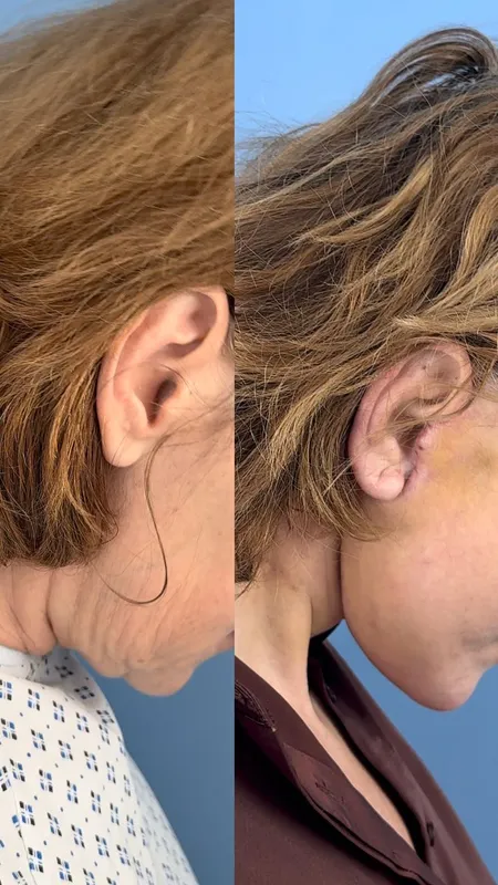 Before and after deep plane facelift — -1-year-old patient, frontal view by Dr. Telman Arakelyan