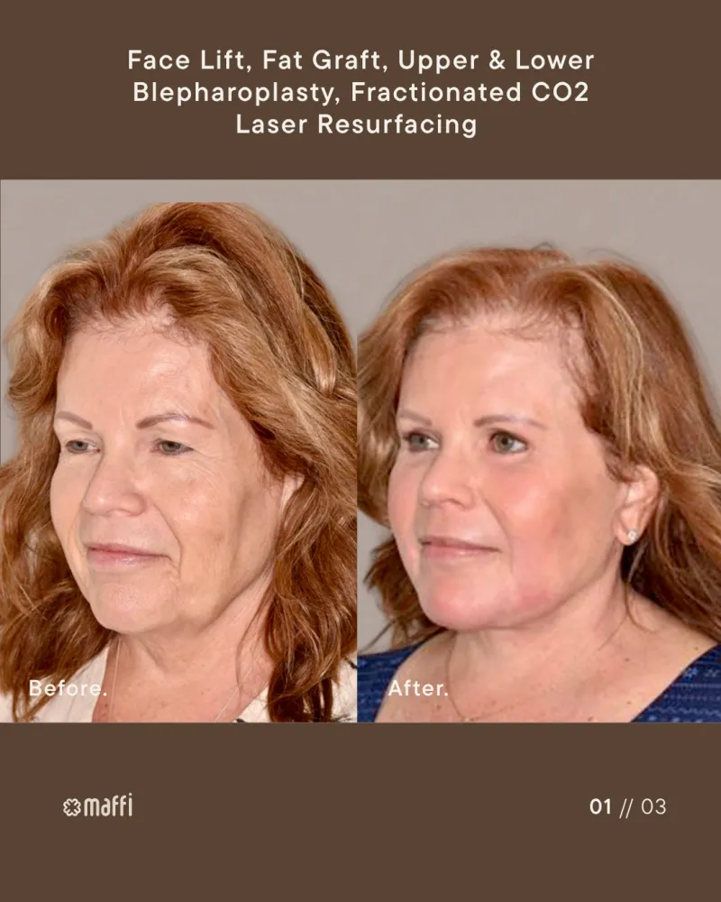 Before and after — Dr. Terry Maffi