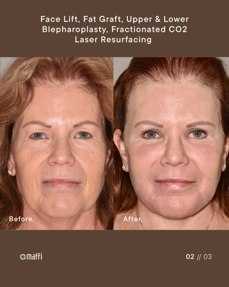 Before and after — Dr. Terry Maffi