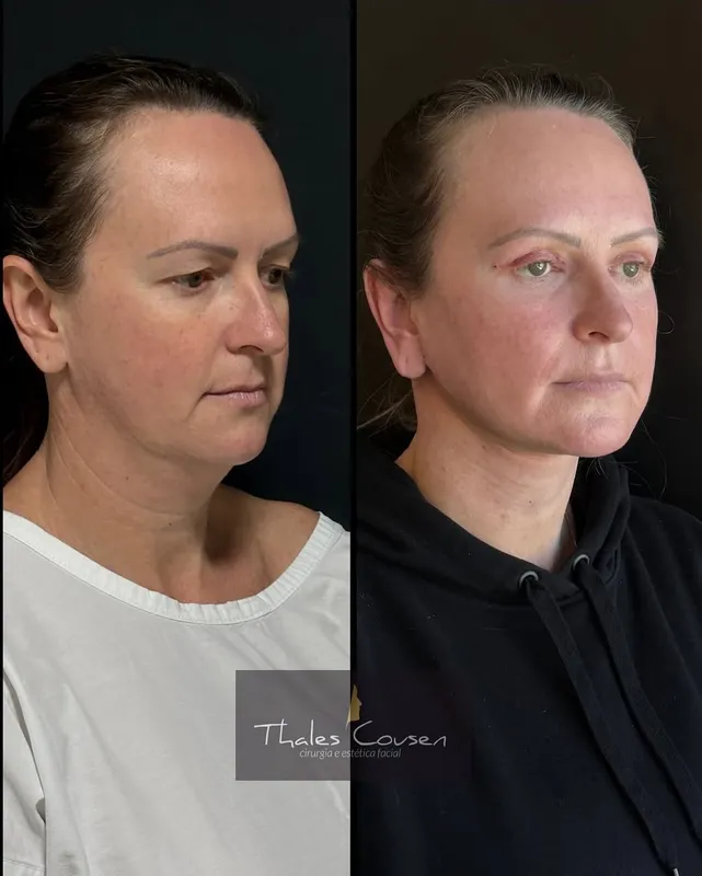 Before and after deep plane facelift, frontal view by Dr. Thales Cousen