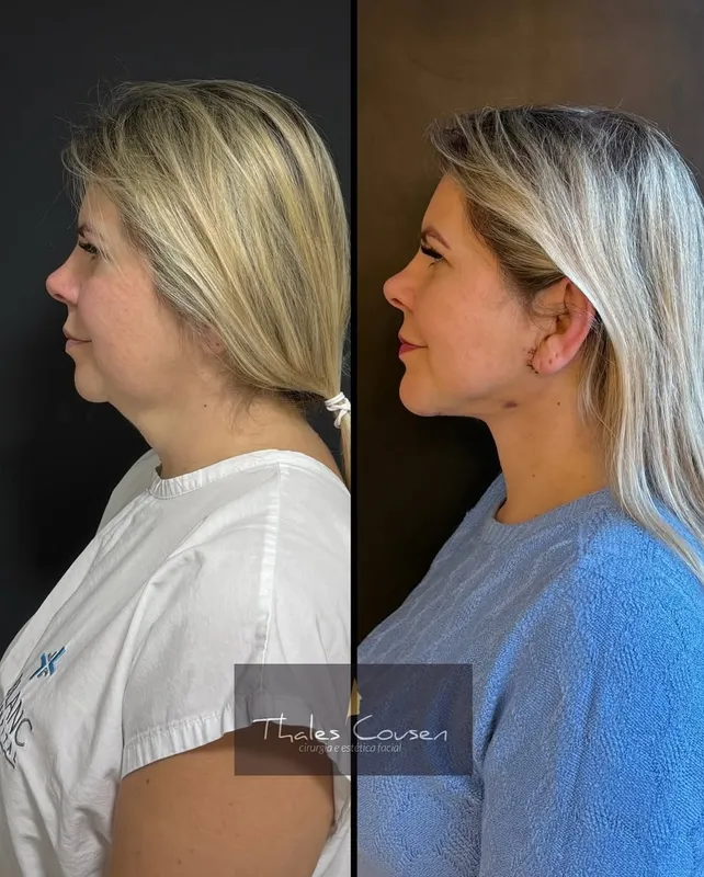 Before and after deep plane facelift, frontal view by Dr. Thales Cousen