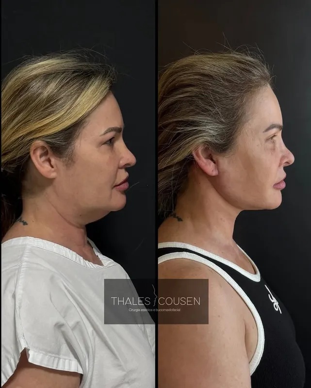 Before and after deep plane facelift, frontal view by Dr. Thales Cousen