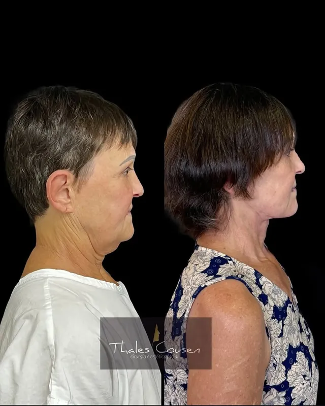Before and after deep plane facelift, frontal view by Dr. Thales Cousen