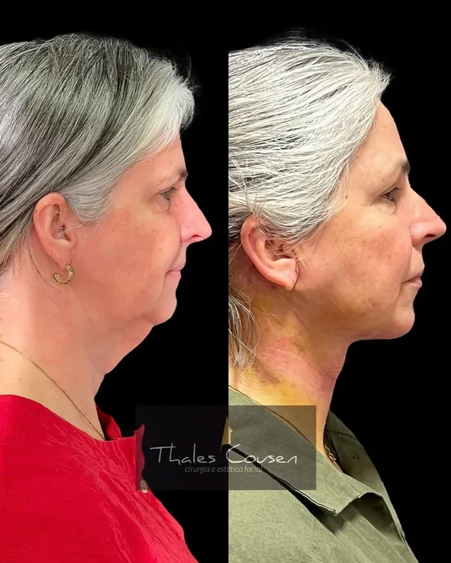 Before and after deep plane facelift, frontal view by Dr. Thales Cousen