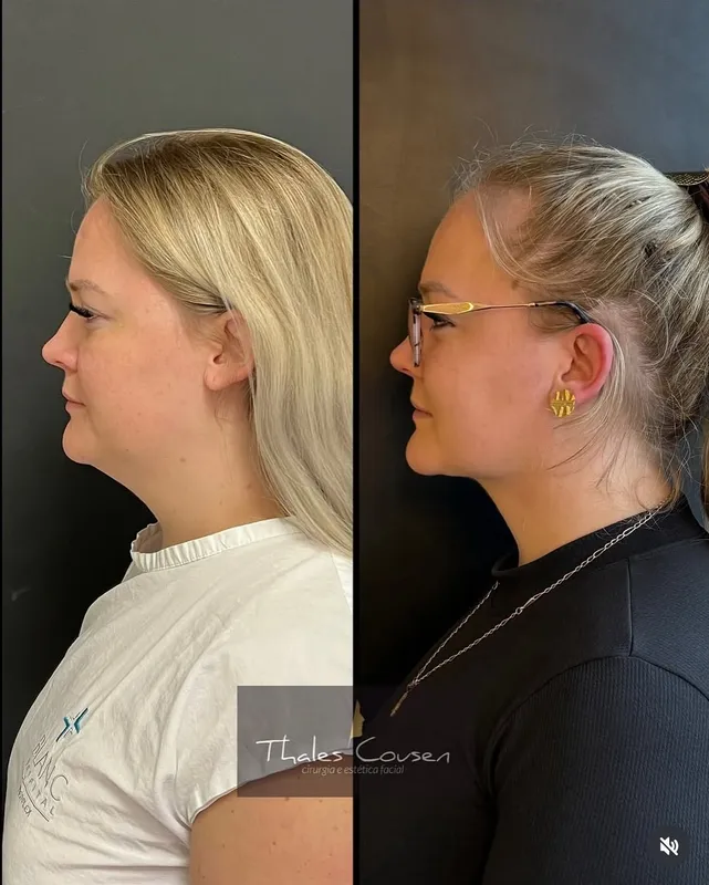 Before and after deep plane facelift, frontal view by Dr. Thales Cousen