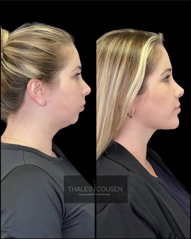 Before and after deep plane facelift, frontal view by Dr. Thales Cousen