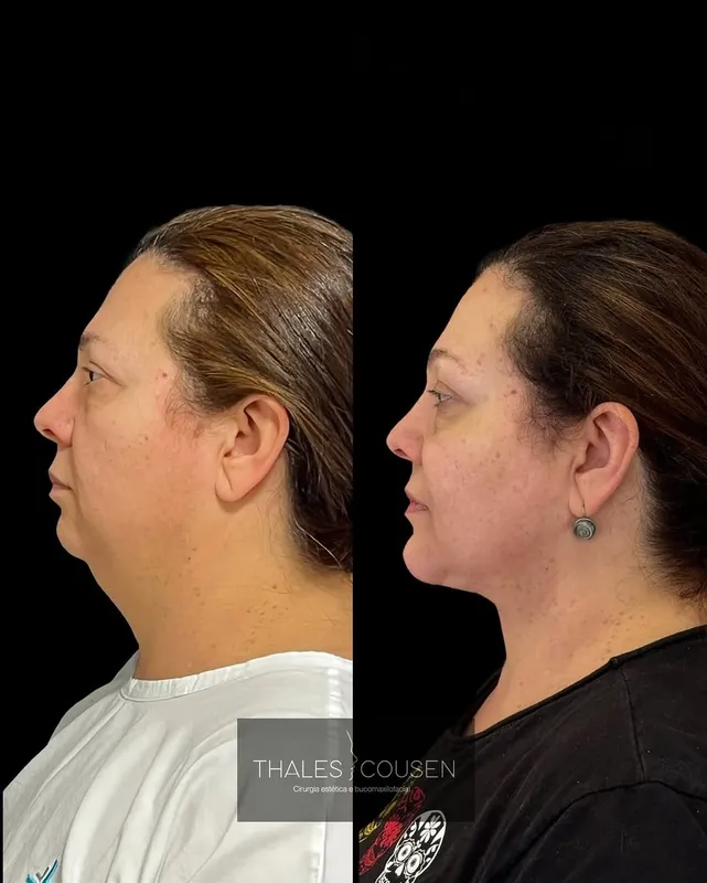 Before and after deep plane facelift, frontal view by Dr. Thales Cousen