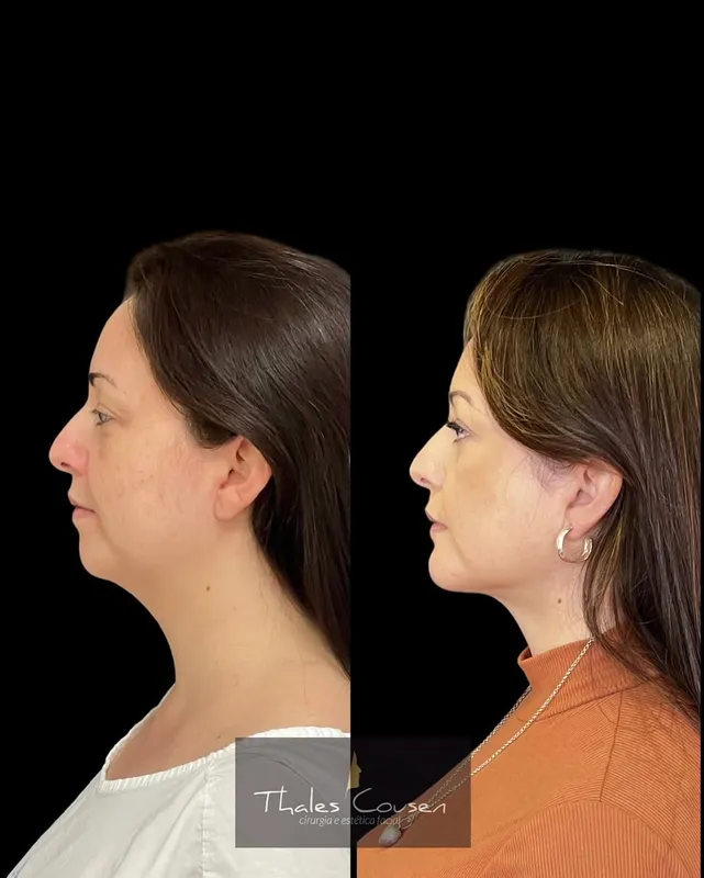 Before and after deep plane facelift, frontal view by Dr. Thales Cousen