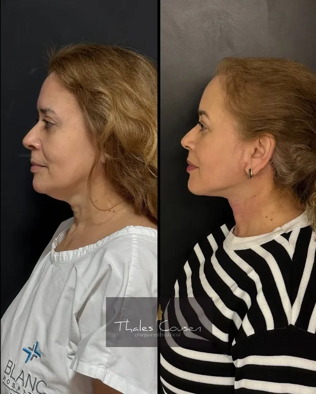 Before and after deep plane facelift, frontal view by Dr. Thales Cousen