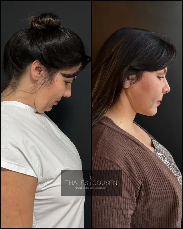 Before and after deep plane facelift, frontal view by Dr. Thales Cousen