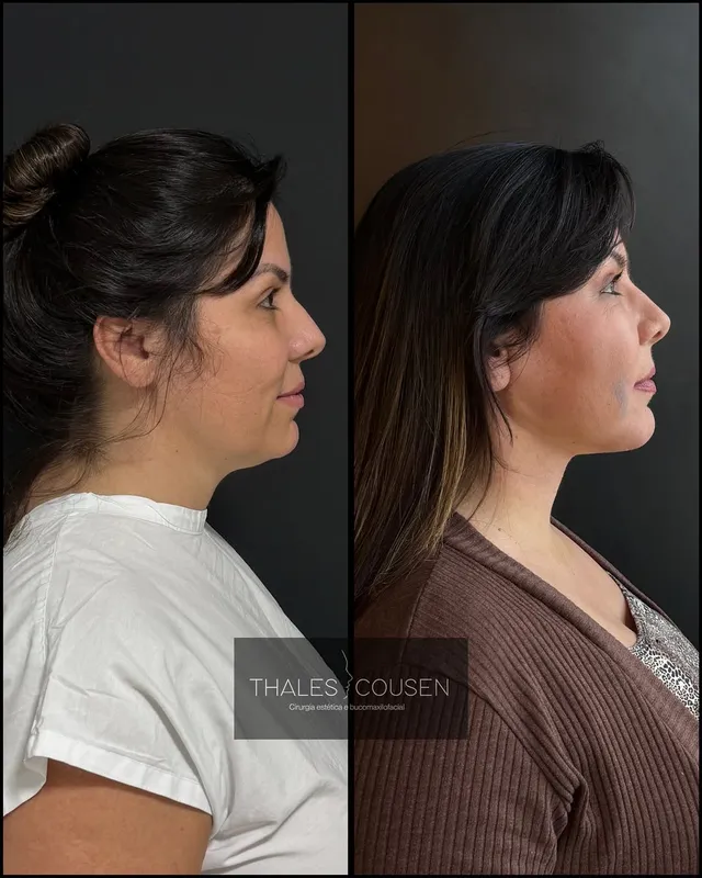Before and after deep plane facelift, frontal view by Dr. Thales Cousen