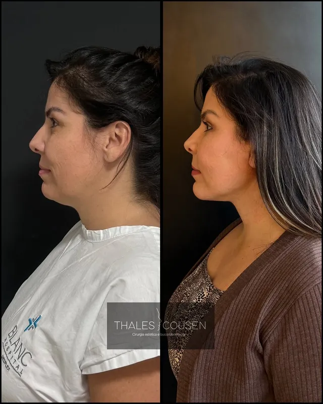 Before and after deep plane facelift, frontal view by Dr. Thales Cousen