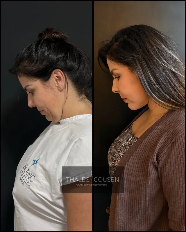Before and after deep plane facelift, frontal view by Dr. Thales Cousen