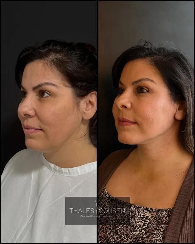Before and after deep plane facelift, frontal view by Dr. Thales Cousen