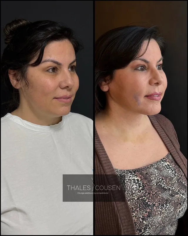 Before and after deep plane facelift, frontal view by Dr. Thales Cousen