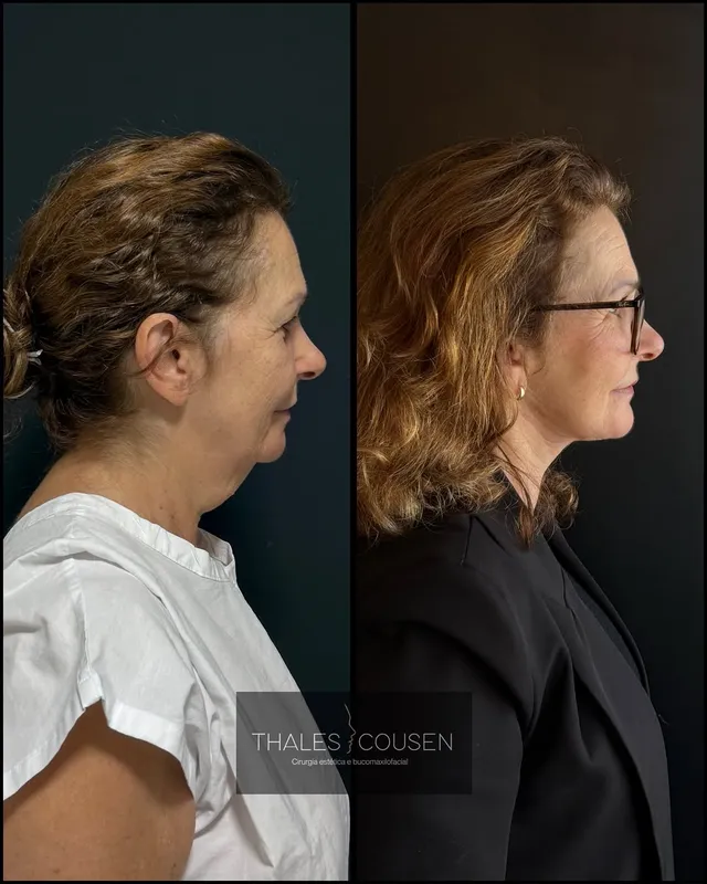 Before and after deep plane facelift, frontal view by Dr. Thales Cousen