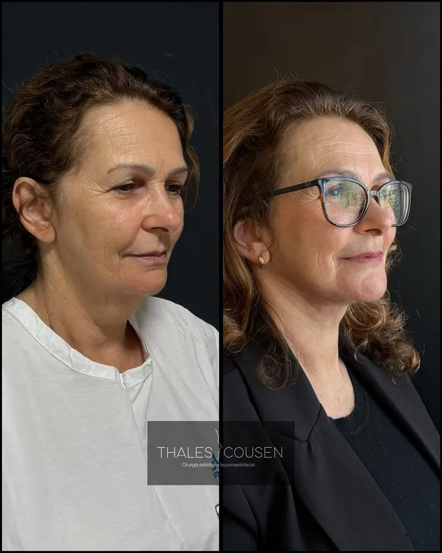 Before and after deep plane facelift, frontal view by Dr. Thales Cousen