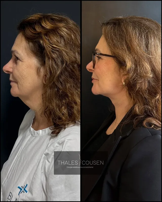 Before and after deep plane facelift, frontal view by Dr. Thales Cousen