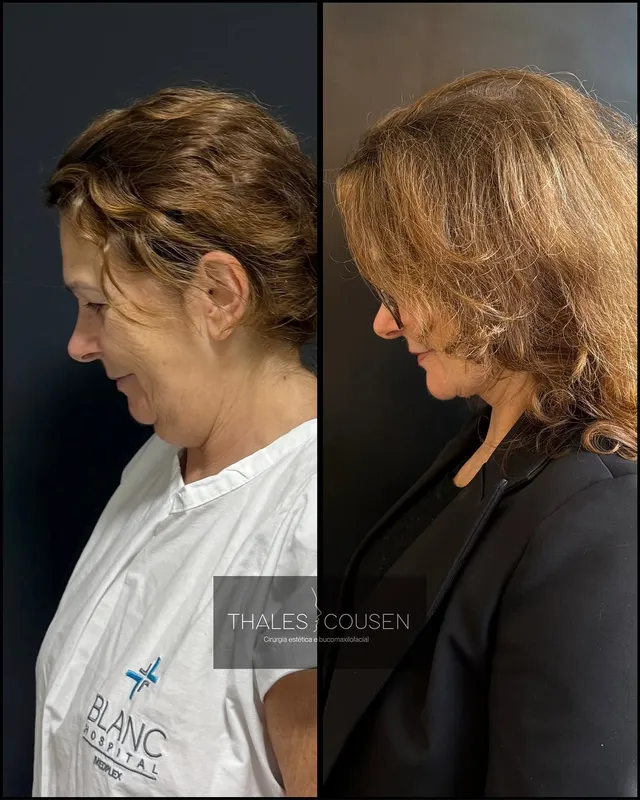 Before and after deep plane facelift, frontal view by Dr. Thales Cousen