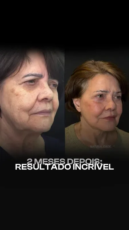 Before and after deep plane facelift — -1-year-old patient, frontal view by Dr. Thiago Barcelos