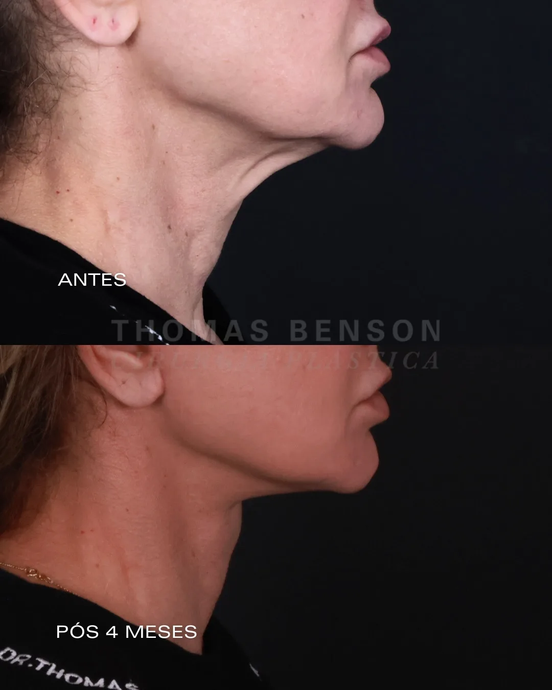 Before and after deep plane facelift — 45-year-old woman, left profile view, 4mo post-op by Dr. Thomas Benson