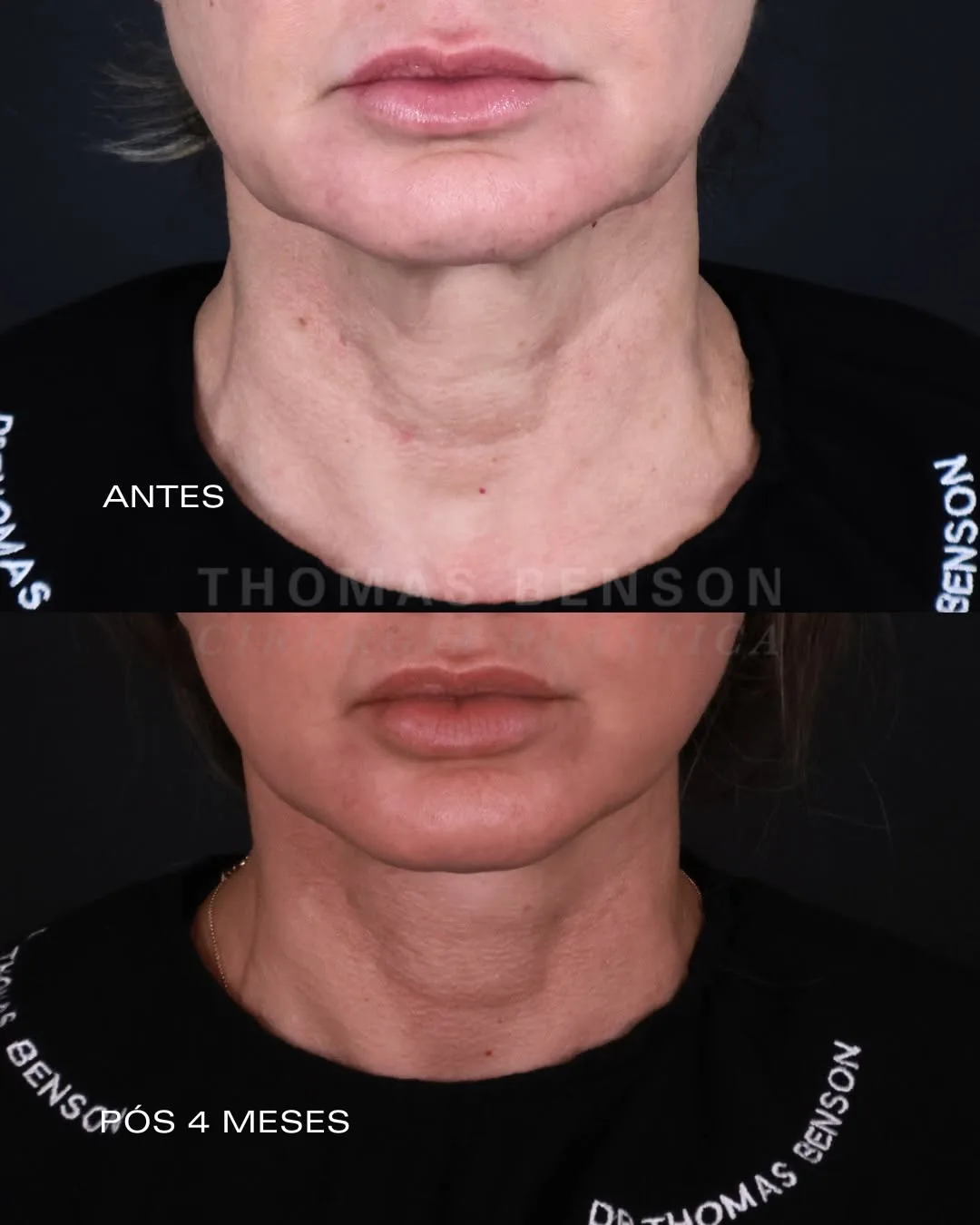Before and after deep plane facelift — 45-year-old woman, frontal view, 4mo post-op by Dr. Thomas Benson