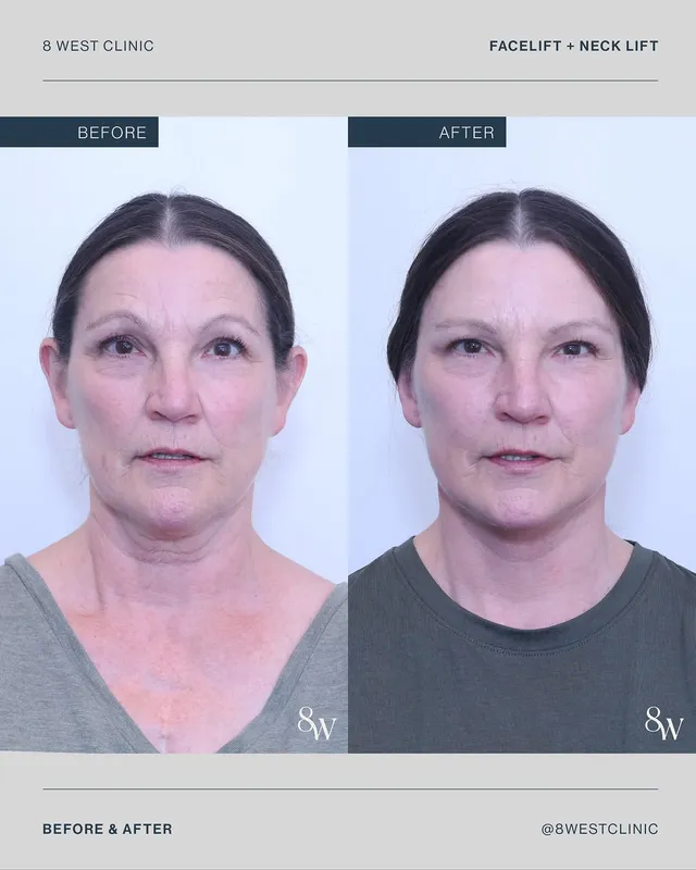 Before and after — Dr. Thomas Buonassisi