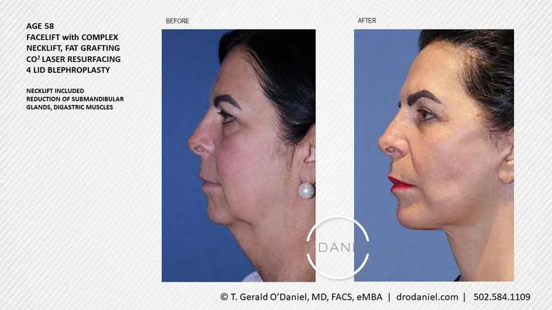 Before and after — Dr. Thomas Gerald O'Daniel