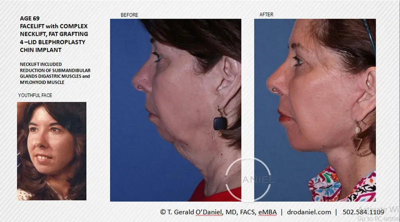 Before and after — Dr. Thomas Gerald O'Daniel
