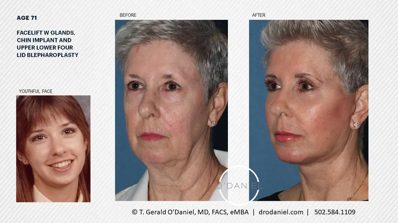 Before and after — Dr. Thomas Gerald O'Daniel