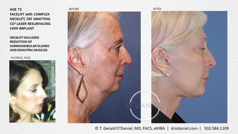 Before and after — Dr. Thomas Gerald O'Daniel