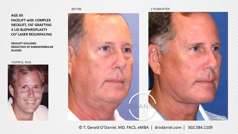 Before and after — Dr. Thomas Gerald O'Daniel