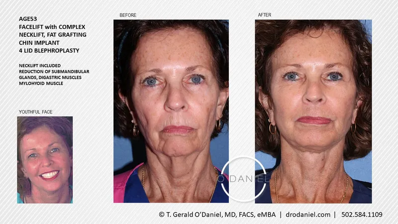 Before and after — Dr. Thomas Gerald O'Daniel