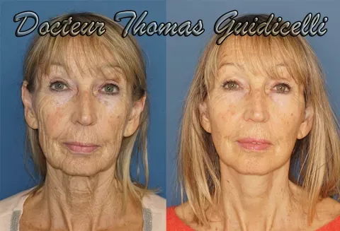 Before and after deep plane facelift — 68-year-old woman, frontal view by Dr. Thomas Guidicelli