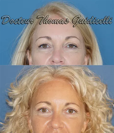 Before and after deep plane facelift — 52-year-old woman, frontal view by Dr. Thomas Guidicelli
