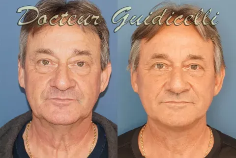 Before and after deep plane facelift — 55-year-old man, frontal view by Dr. Thomas Guidicelli