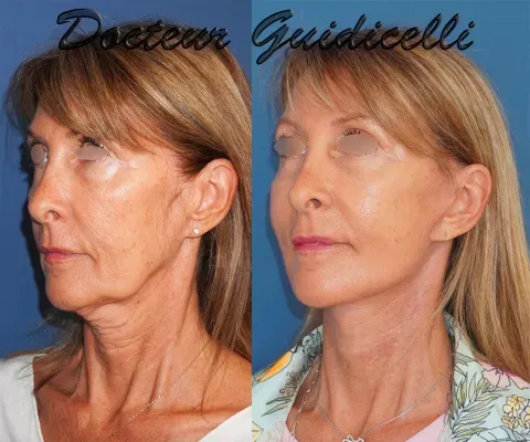 Before and after deep plane facelift — 58-year-old woman, frontal view by Dr. Thomas Guidicelli