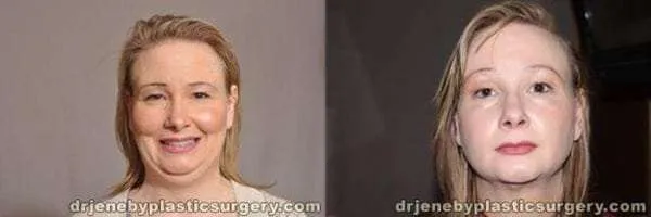 Before and after — Dr. Thomas Jeneby