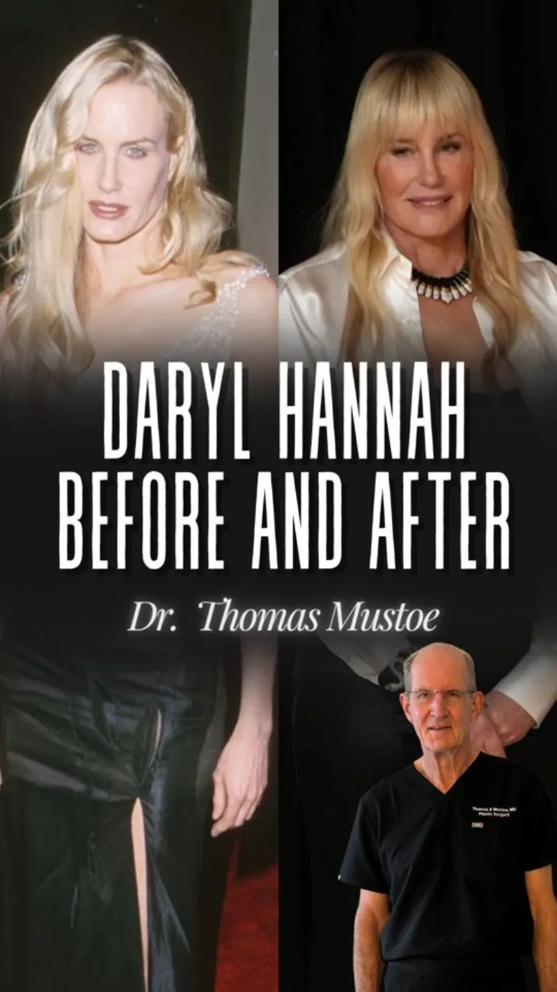 Before and after — Dr. Thomas Mustoe