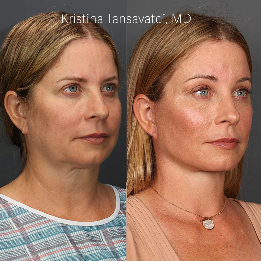 Before and after deep plane facelift — 52-year-old woman, oblique right view, 6mo post-op by Dr. Thomas Taylor