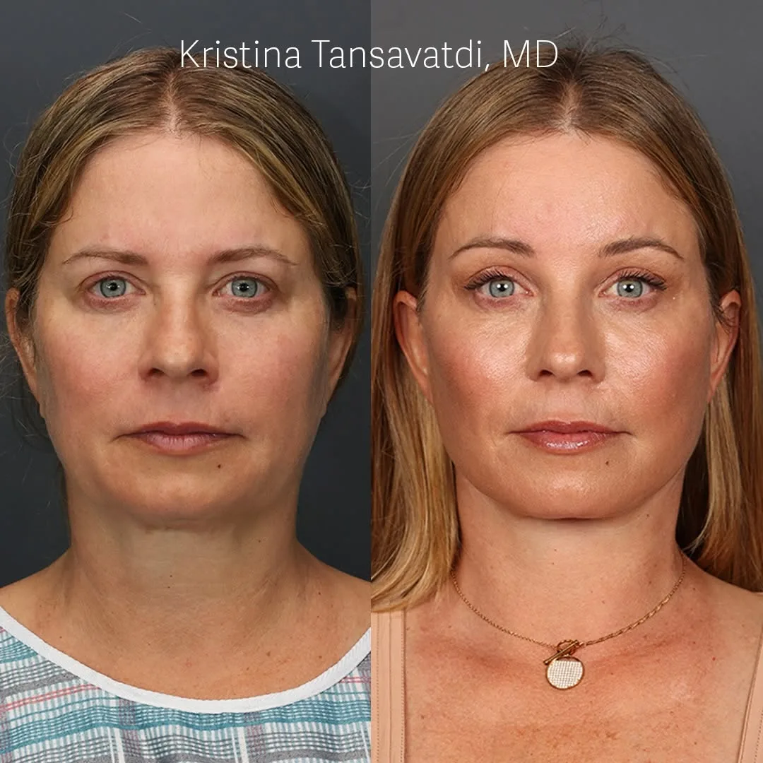 Before and after deep plane facelift — 48-year-old woman, frontal view, 7mo post-op by Dr. Thomas Taylor