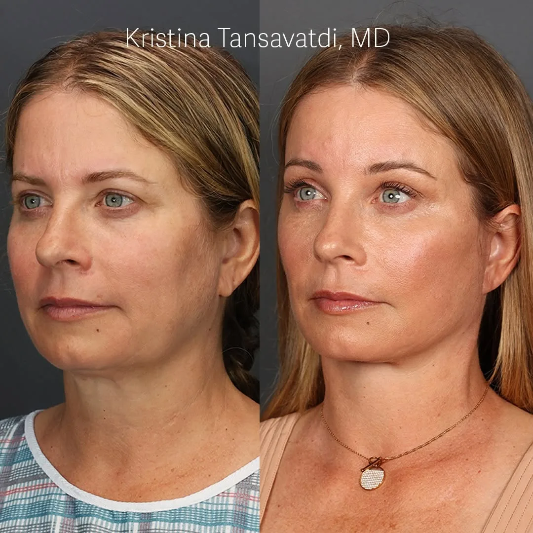 Before and after deep plane facelift — 48-year-old woman, oblique right view, 7mo post-op by Dr. Thomas Taylor
