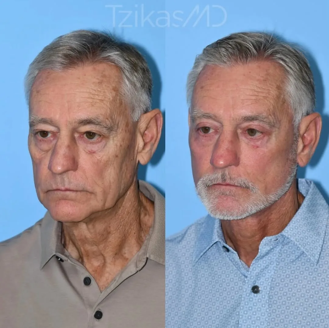 Before and after — Dr. Thomas Tzikas